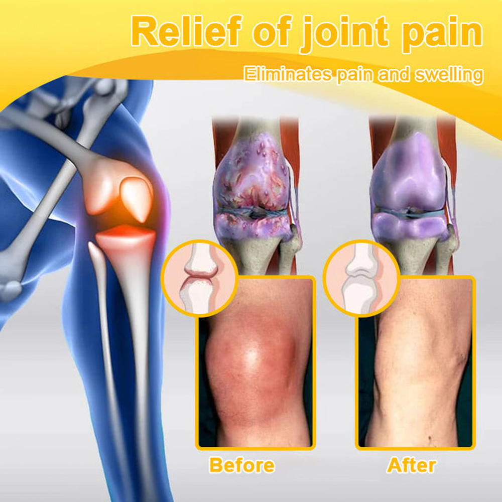 Purelora® Cream with Botulinum Toxin and Bee Venom for Pain Relief and Bone Regeneration