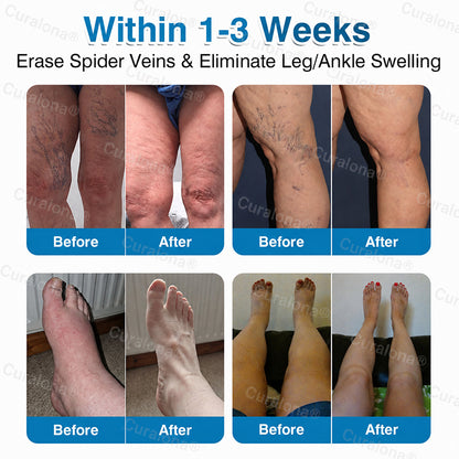 🇬🇧👨‍⚕️✅💙Curalona® VeinRepair Microneedle Patch Roll⚡Instant Relief, Long-Term Results