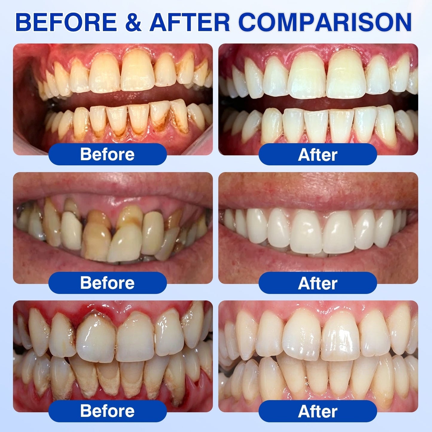 🇬🇧🦷Curalona® GumRevive Periodontal Repair Gel (For Bleeding Gums, Gum Recession & Loose Teeth)
