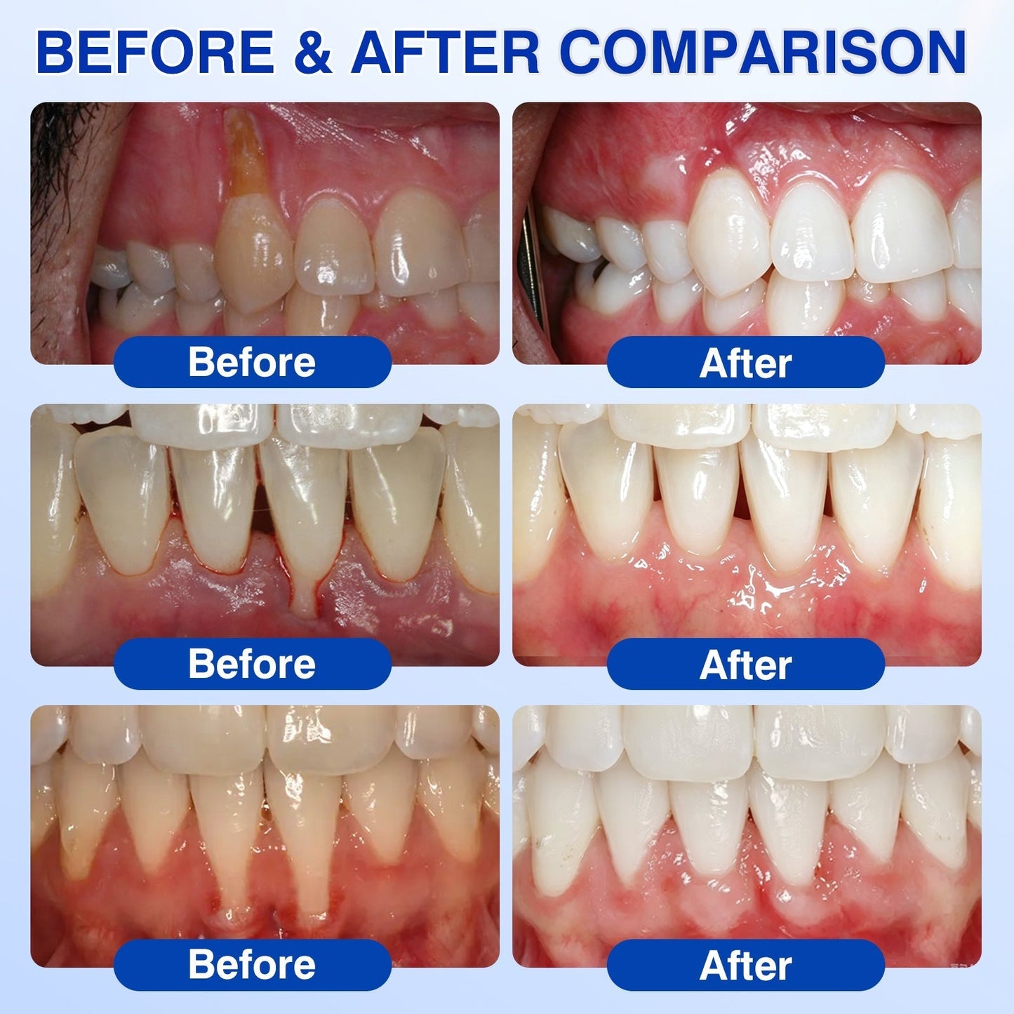 🇬🇧🦷Curalona® GumRevive Periodontal Repair Gel (For Bleeding Gums, Gum Recession & Loose Teeth)